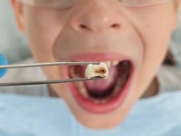 Best Emergency Treatment for Dental Infections or Abscesses in Central Heights Midland City, AZ